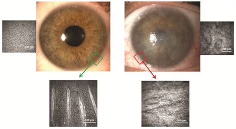 Goals and Challenges of Stem Cell-Based Therapy for Corneal Blindness ...