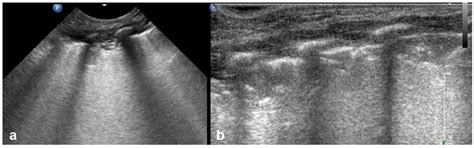 Lung Ultrasound in Pediatrics: A Review with Core Principles That Every ...