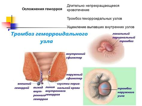 Геморрой. Стадии геморроя - презентация онлайн