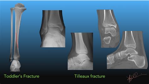Pediatric Tibial Fractures | UW Emergency Radiology