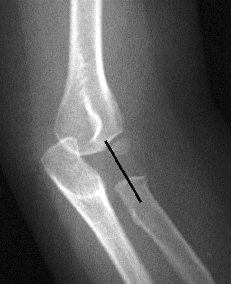 Nursemaid Elbow Vs Tennis Elbow at Joel Sherwin blog