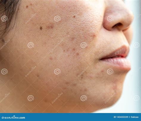 Problems Facial Skin is Acne and Blemishes Stock Image - Image of ...