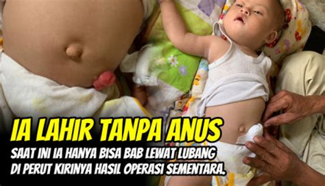 Lahir Tanpa Anus, Bayi 9 Bulan Ini Berjuang Menahan Sakit - BerkahYatim