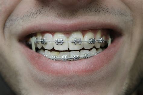How To Get My Braces Off Faster | Gragg Orthodontics
