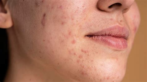 Benefits Of Using Clove Oil For Treating Acne And Dark Spots | OnlyMyHealth