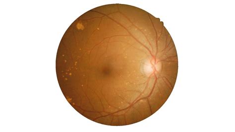 Blurry vision – how to manage eye problems that affect your daily life