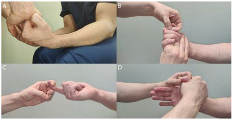 Anterior Interosseous Nerve Syndrome