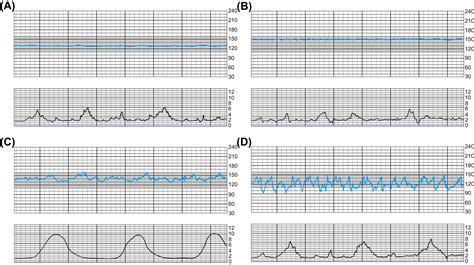 Intrapartum Fetal Monitoring - Clinical Tree