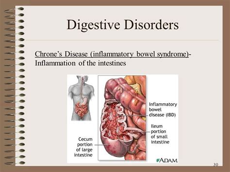 Common Digestive Disorders 的图像结果