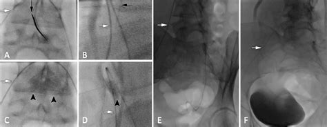 Superior Hypogastric Nerve Block as Post–Uterine Artery Embolization ...