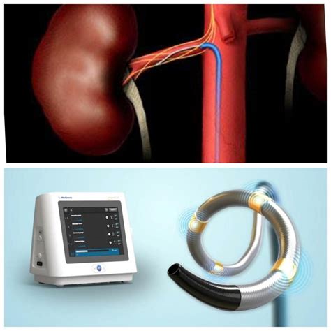 A Novel Percutaneous Treatment for Hypertension: Renal Denervation (RDN) using Spyral Catheter ...
