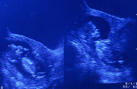 孕初期有这四大反常感觉，说明孕囊胎芽正茁壮成长，孕妈别太担心|孕囊|怀孕|胎心_新浪新闻