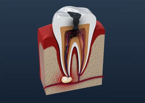 Image result for Abscessed Tooth Explosion