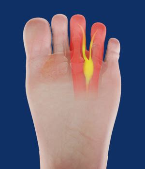 Morton’s Neuroma Southlake | Foot Surgery | Neurectomy Fort Worth TX
