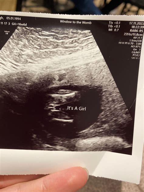 17Weeks Pregnant Ultrasound