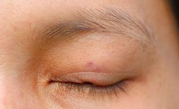 上眼皮肿因何而起，如何消肿效果好，需打通血液循环|上眼皮|眼皮|消肿_新浪新闻