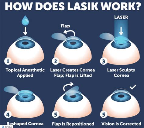 Is LASIK Worth the Cost? The Answer Helps Explain How Stocks Work. - The Best Interest