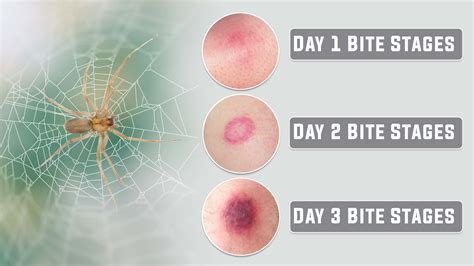 Spider Bite Abscess Treatment at Ali Winston blog
