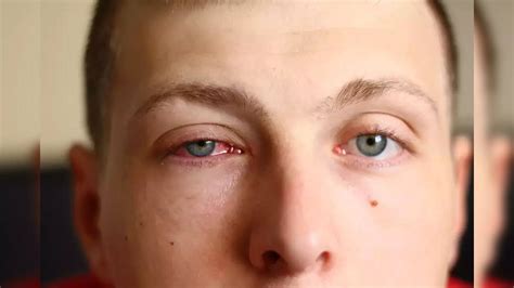 BMC advisory on Conjunctivitis cases spike: Here's how to ensure your ...