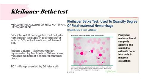 RHESUS NEGATIVE IN PREGNANCY .pptx