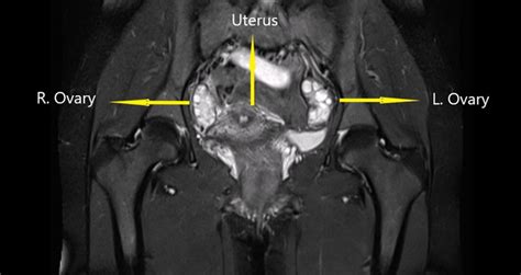 MRI tool can diagnose difficult cases of ovarian cancer: JAMA
