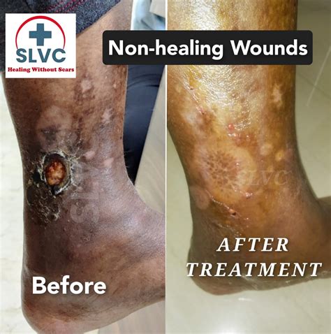 Revolutionary Non-Surgical Treatment for Non-Healing Wounds | SLVC Clinic