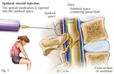 Injection Back Pain 的图像结果