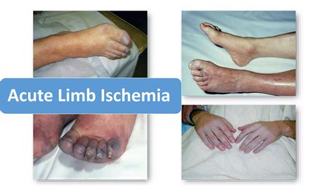 Acute limb ischemia | PPTX
