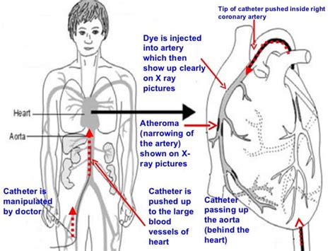 Coronary Angiogram Procedure 的图像结果