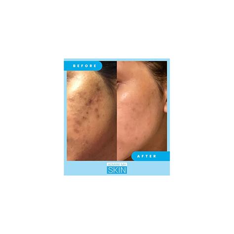 Admire My Skin Dark Spot Remover + Retinoid Cream + India | Ubuy