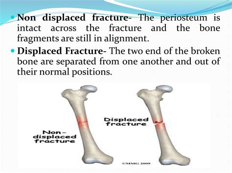 FRACTURE PPT.pptx