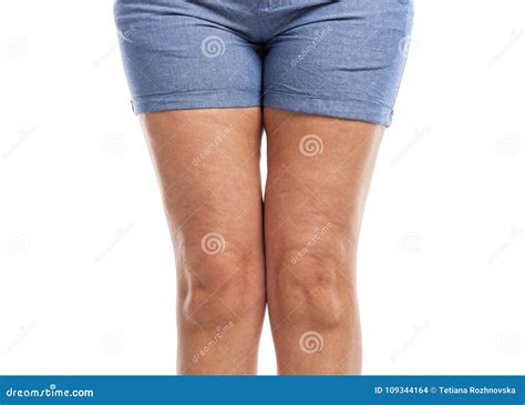 Fat and Cellulite on the Legs. Stock Photo - Image of health, hand: 109344164