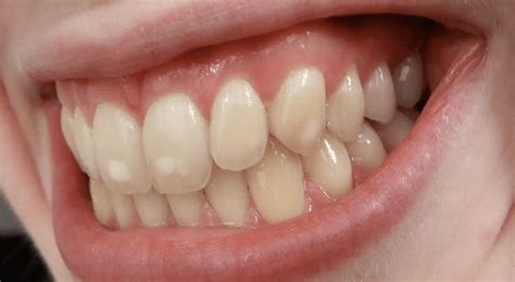 Image result for Bottom Teeth Calcium Buildup