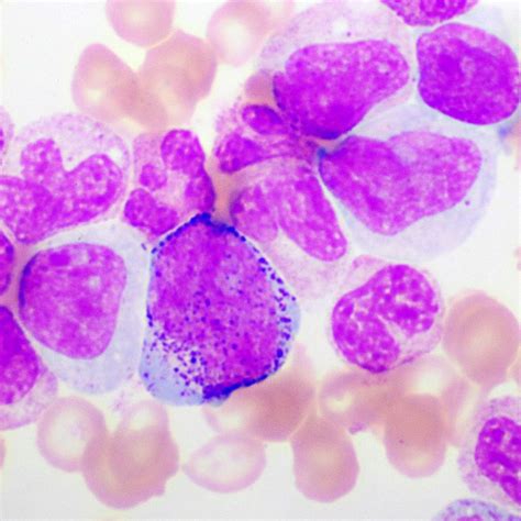 Neue Richtlinien und ein potenter BCR-ABL1-Inhibitor - Onkologie ...