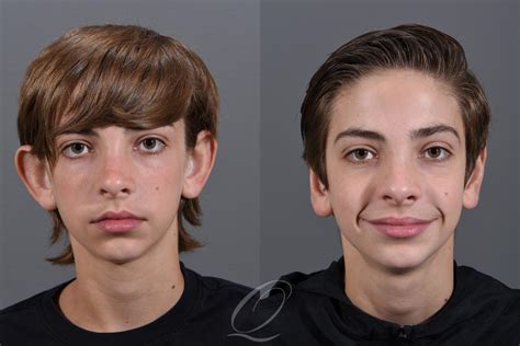 Otoplasty (Ear Pinning) Before & After Photos Patient 1344 | Serving Rochester, Syracuse ...