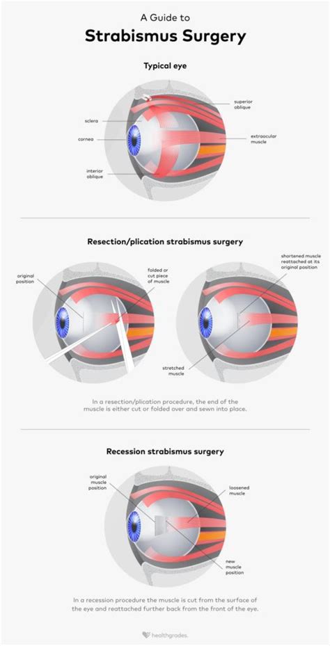 Strabismus Surgery: Procedure, Effectiveness, and Risks