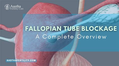 Image result for Fallopian Tube Surgery