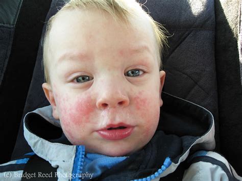 Kuvatulokset haulle penicillin allergy