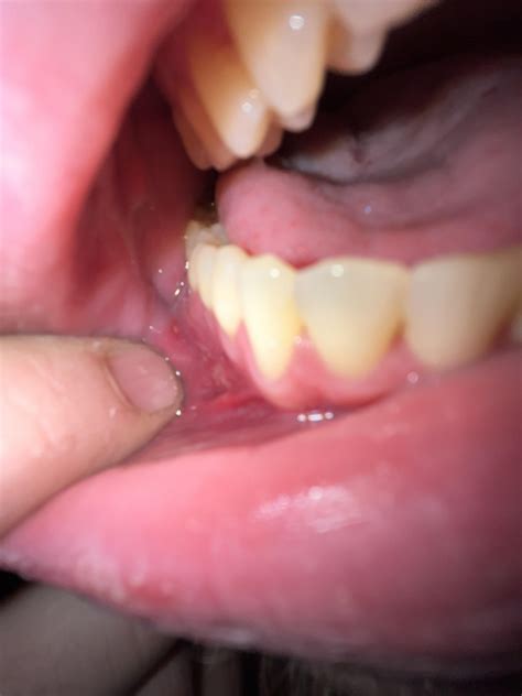 Sores on roof of mouth and gum : r/askdentists