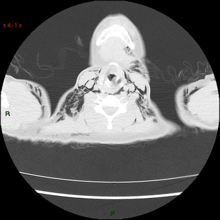Rare case of Postpartum Hamman's syndrome presenting with facial ...