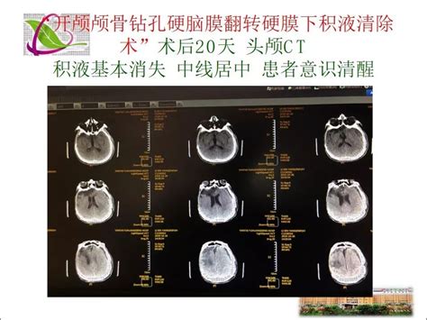 成功救治重型颅脑损伤患者一例丨颅脑创伤-神经重症病例周刊（第58期）