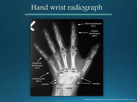Hand Wrist Radiography | PPTX