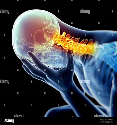 headache due to neck pain Stock Photo - Alamy