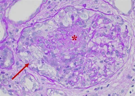 Positive Anti–Glomerular Basement Membrane and Proteinase 3 ...