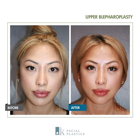 How to remove double eyelid online