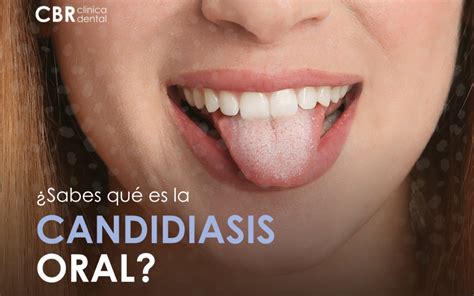 ¿Qué es la candidiasis oral? - CBR Clínica dental | Dentistas en Palma ...