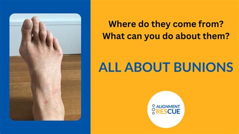What is a Bunion? How Do You Get Bunions?