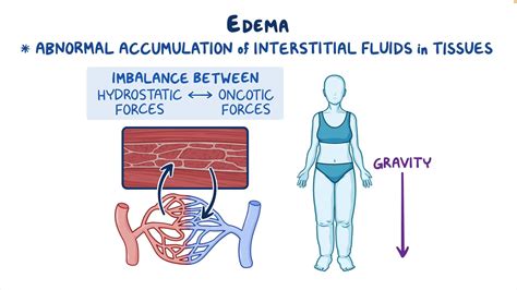 Leg Edema Classification at Thomas Butterfield blog