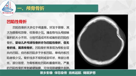 3D打印重建颅骨治好“狭颅症”患儿 中国首例 - 三湘万象 - 湖南在线 - 华声在线