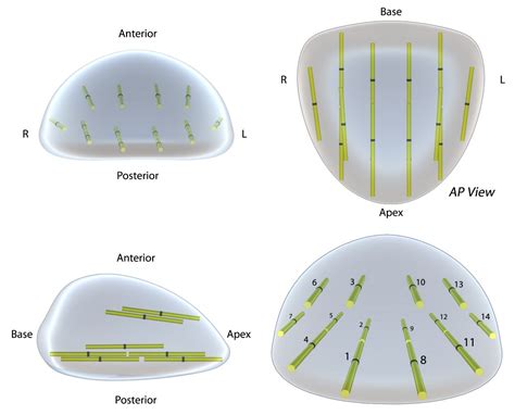 Micro-Ultrasound Guided Transperineal Prostate Biopsy: A Clinic-Based Procedure